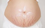Cách khắc phục rạn da khi mang thai và sau sinh hiệu quả 