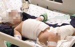 Bé gái bị bỏng nặng vì vấp ngã vào bình nước sôi siêu tốc