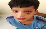 Săn cá bằng súng tự chế, bé 8 tuổi bị 3 đinh kim loại ghim vào hốc mắt