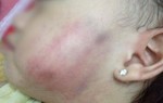 Phụ huynh tố giáo viên mầm non đánh con tím bầm mặt