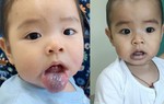 Nụ cười trở lại với bé 2 tuổi bị bướu dị dạng mạch máu 
