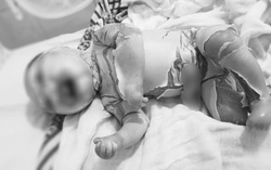 Bé sinh non có da như vảy cá ở Hà Giang được điều trị thế nào?