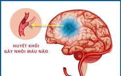 Người phụ nữ đột ngột méo miệng, mất ý thức khi đang phơi quần áo
