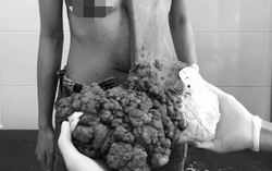 Cô gái 29 tuổi mang khối u 10kg ở ngực suốt 10 năm