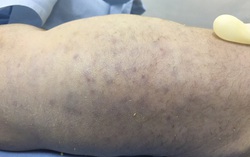 Nhiễm virus gây bệnh thủy đậu, giời leo từ trong bào thai, trẻ sơ sinh tử vong sau 11 tiếng cấp cứu