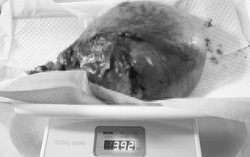 Khối u xơ nặng gần 4kg chiếm trọn thân tử cung