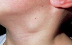 Cảnh báo dấu hiệu ung thư nếu 4 bộ phận trên cơ thể "trồi ra"