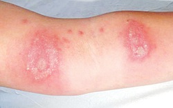 Cẩn thận với viêm da tiếp xúc do côn trùng mùa mưa bão