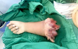 "Cứu sống" cẳng tay phải bé 8 tuổi bị đứt lìa