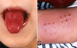 Cậu bé đầu tiên ở Anh tử vong vì bệnh lạ nghi do biến chứng của Covid-19