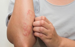 Phòng tránh hiệu quả 5 bệnh mùa hè 