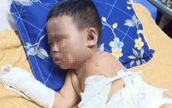 Không cầm được nước mắt trước cảnh bé trai bỏng khắp người vì bị ném bom xăng đêm sinh nhật