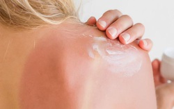 Cần làm gì khi bị mụn nước do cháy nắng?