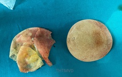 Nâng ngực ở thẩm mỹ viện tư, nữ bệnh nhân bị vỡ túi ngực mà không biết