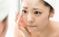 Điểm danh 3 thói quen khiến da mặt xuất hiện vết thâm và sẹo mụn