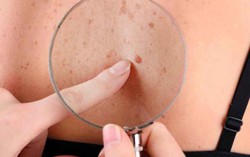 Nếu sắp bị ung thư, trên da sẽ cùng lúc có 4 dấu hiệu này