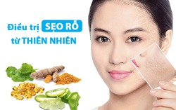 Lấp đầy sẹo rỗ với các nguyên liệu tự nhiên tại nhà