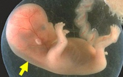 Độ mờ da gáy là gì? Khi nào cần đo độ mờ da gáy ở thai nhi?