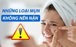 Các loại mụn không nên tự nặn và tuyệt đối không được nặn 