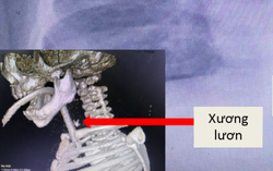Bé trai bị thủng thực quản, suy hô hấp nặng do hóc xương lươn