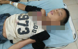 Bé 12 tuổi chấn thương nặng vì bị thân cây đâm xuyên qua cổ