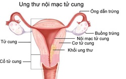 Niêm mạc tử cung dày bất thường không điều trị, 3 năm sau bị ung thư nội mạc tử cung