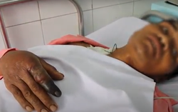 Người đàn ông thoát chết khi bị rắn hổ mang chúa dài 2,4m cắn