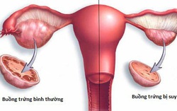 3 tháng không có kinh, cô gái độc thân đi khám tá hỏa phát hiện buồng trứng lão hóa như người người 50