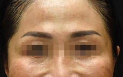 Độc tố botulinum có thể giúp trẻ hóa làn da, làm thon gọn khuôn mặt