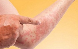 Cách phòng ngừa một số bệnh về da dễ nặng lên vào mùa đông