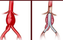 Cứu bệnh nhân vỡ phình động mạch chậu chung nguy hiểm tính mạng