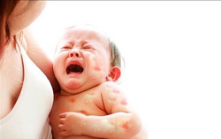 Tỷ lệ dị ứng đạm sữa bò ở trẻ dưới 3 tuổi tại Việt Nam là 2,1%