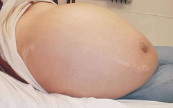 Nguyên nhân, triệu chứng và cách điều trị bệnh xơ gan cổ trướng
