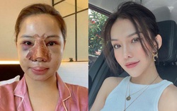 Nữ diễn viên "Chạy trốn thanh xuân" công khai quá trình "đập mặt xây lại"
