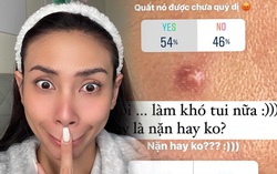 Võ Hoàng Yến nặn mụn cũng hỏi ý kiến cư dân mạng