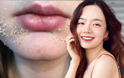 Nghe beauty blogger kể chuyện dùng Retinol/Tretinoin, chị em bớt sợ "hỏng da"