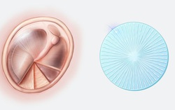 Phương pháp mới chữa bệnh thủng màng nhĩ
