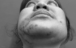 Tiêm filler trị "gò má cao", người phụ nữ phải nhập viện khẩn cấp