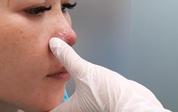 Môi phù nề, mũi có mủ sau khi tiêm filler làm đẹp