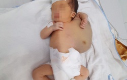 Bóc khối u bạch tuyết khổng lồ khỏi cơ thể bé 10 ngày tuổi