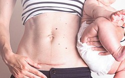 Cùng đẻ mổ, tại sao có người sẹo "mảnh như sợi chỉ", người lại "to như con rết"