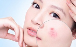 Vì sao dùng kem dưỡng ẩm bị nổi mụn ?