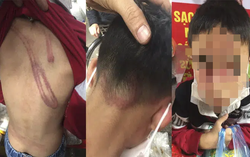 Vụ cháu bé 7 tuổi bị bạo hành dã man: Công an làm việc với người bố