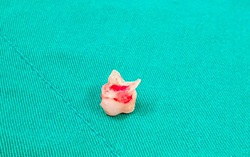 Răng sữa mắc kẹt trong phế quản bé gái 8 tuổi