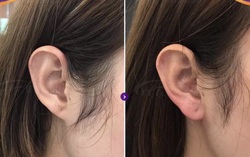 Tiêm filler vào tai để "đổi vận", thiếu nữ phải nhập viện vì hoại tử