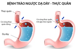 Nhiều người nhầm lẫn hội chứng trào ngược thực quản dạ dày với viêm họng
