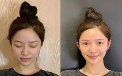 Cơn sốt phẫu thuật để có "tai yêu tinh" trong giới trẻ Trung Quốc