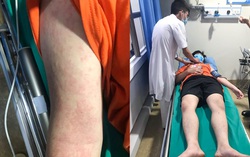 Nam thanh niên sốc phản vệ nguy kịch sau khi ăn con mối