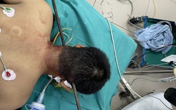 Thanh niên thoát chết khi ngã từ tầng 5 bị thanh sắt xuyên từ cổ qua não 