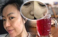 Trị nám tại nhà giúp da sáng khỏe với giá chỉ 3k